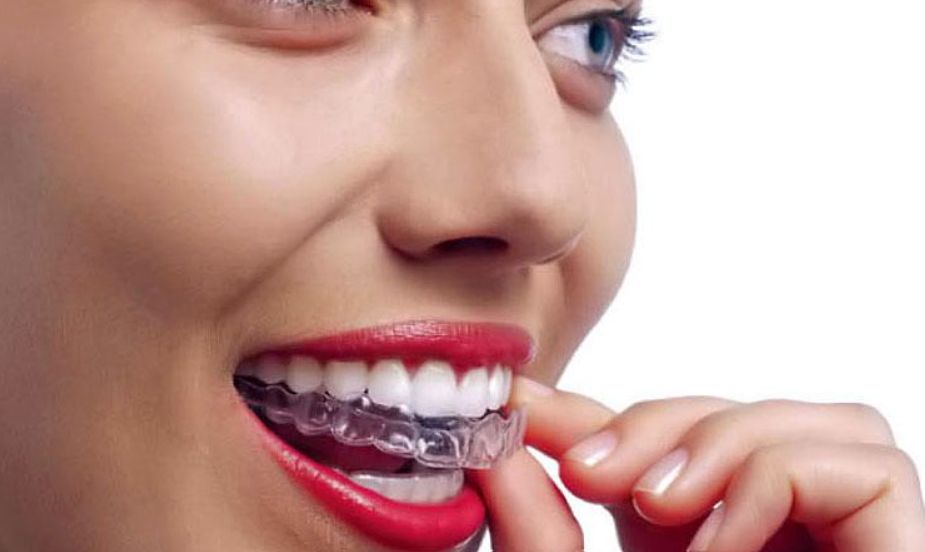 Lijep osmijeh i s aparatićem - Ordinacija dentalne medicine Dentex