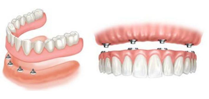 IMPLANTATI