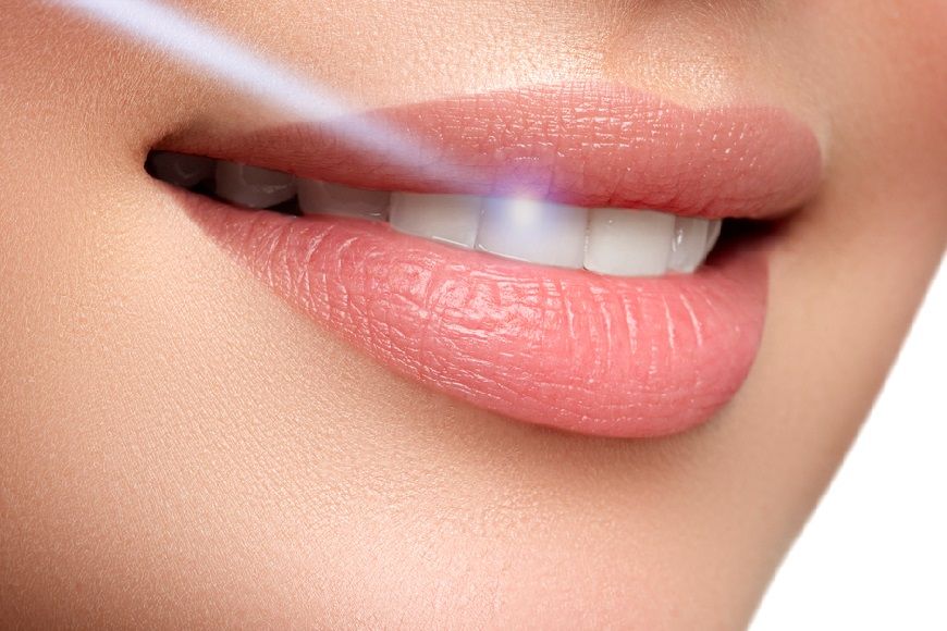 Tretmani dentalnim laserom