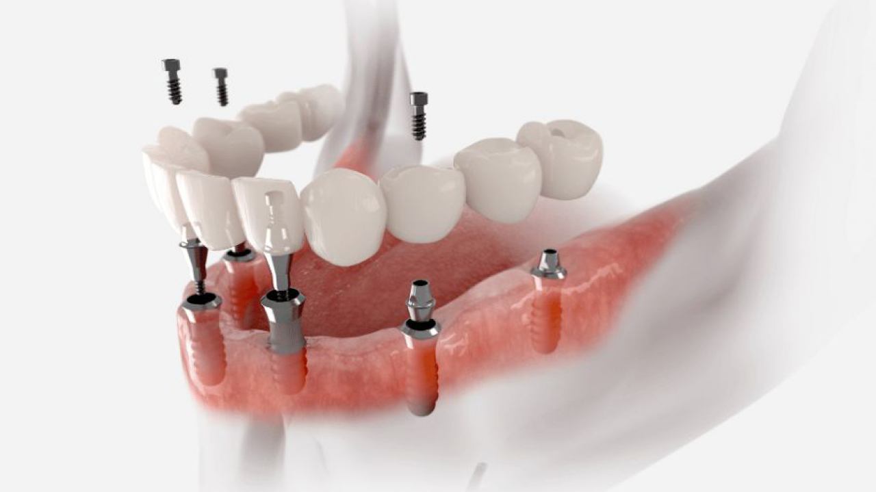 All on 4 zubni implantati