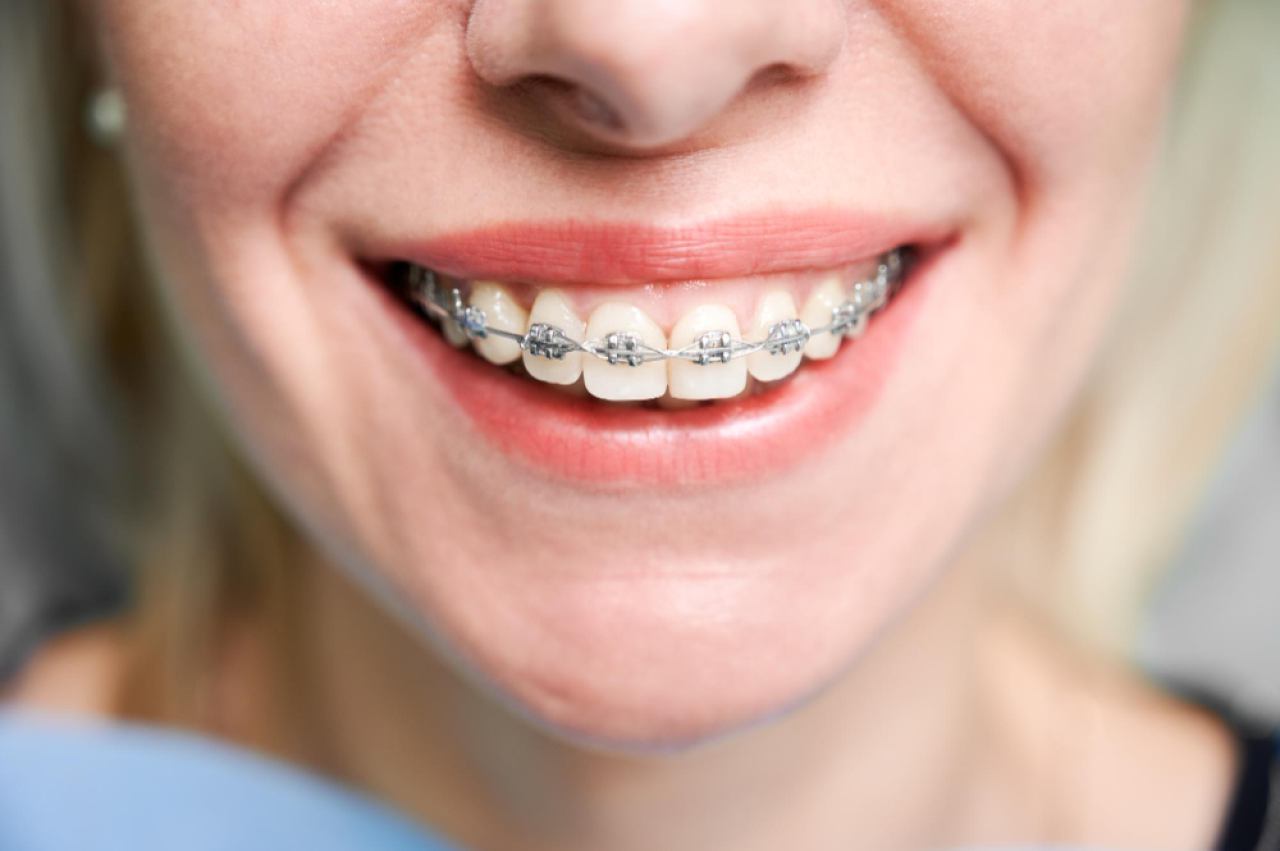 ORTODONCIJA - FIKSNI, MOBILNI, INVISALIGN APARATIĆI