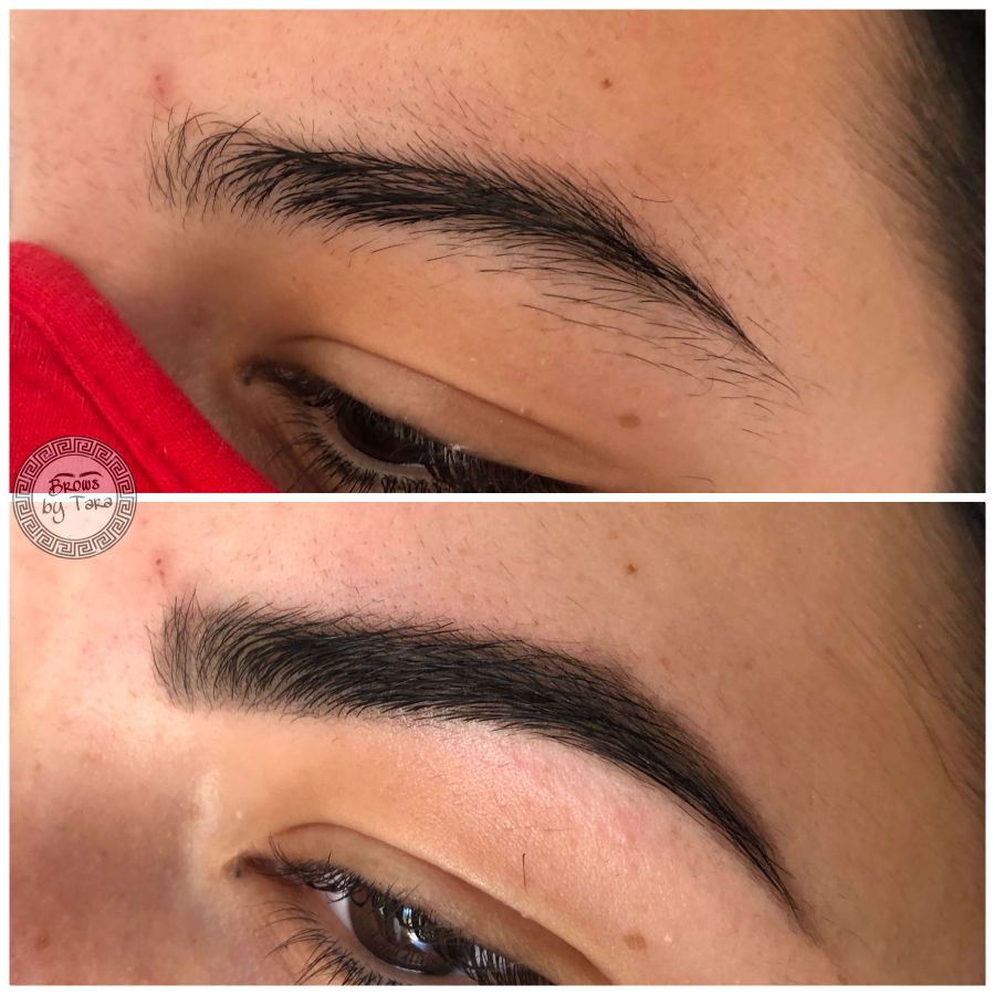 Brow lift