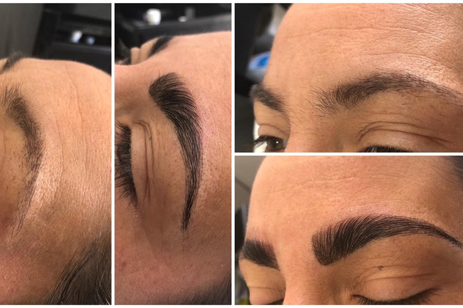 Brow lift