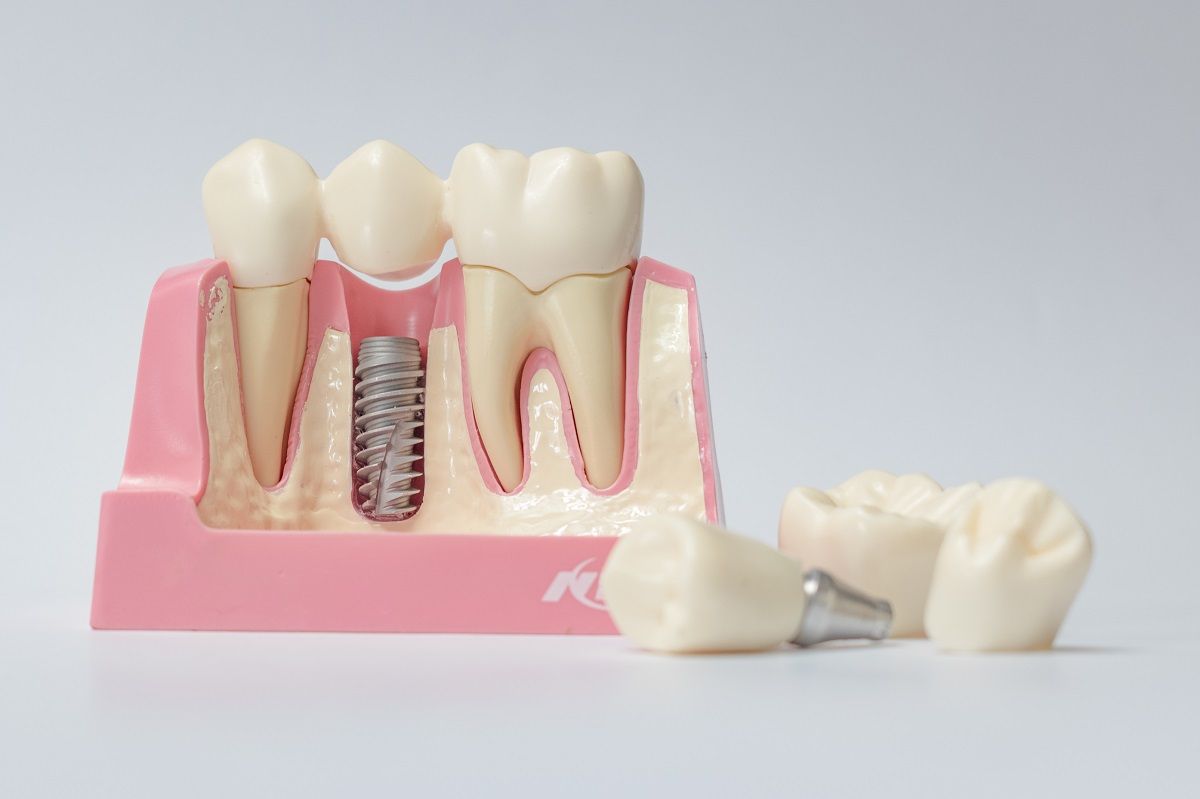 Nedostatak zuba - zdravstveni problem kojeg je važno riješiti što prije