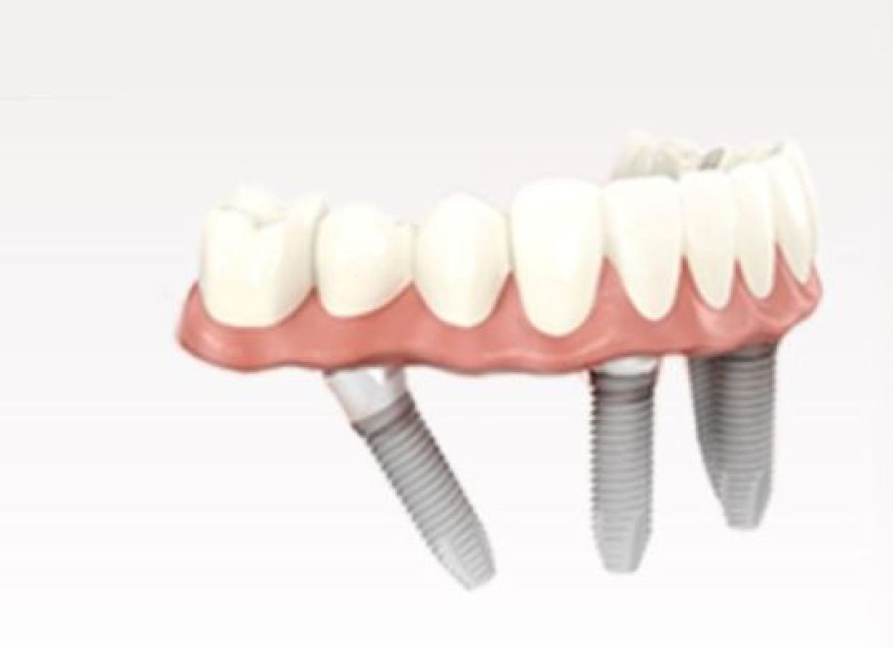 UGRADNJA DENTALNIH IMPLANTATA